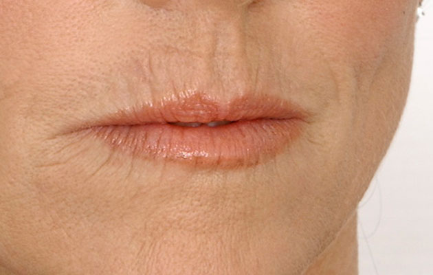 Labios "código de barras"