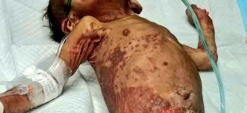 Investigan caso de infante en estado delicado por cuadro de desnutrición El menor presenta quemaduras en todo el cuerpo. Foto: Mayra Madrid.