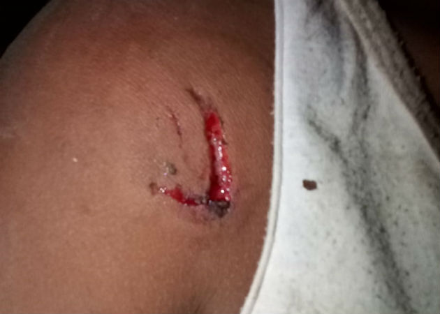 Una menor de trece años es mordida por su primo en Chichica, comarca Ngäbe-Buglé La mordió en el hombro y la mano derecha. Fotos: Mayra Madrid.