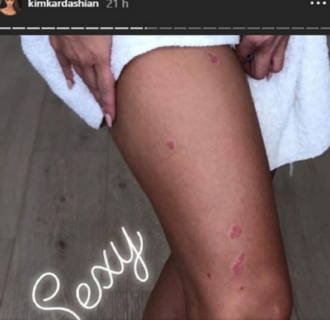 Kim Kardashian muestra sus lesiones de la psoriasis. Foto: Instagram Kim Kardashian muestra sus lesiones de la psoriasis. Foto: Instagram