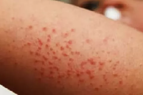 Alerta epidemiológica: Minsa detecta segundo caso de sarampión importado en lo que va del año