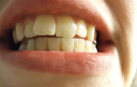Extraen 232 piezas dentales a un joven tras 6 horas de operación en la India