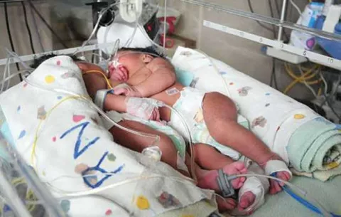 Mueren siamesas bolivianas unidas por el corazón, hígado y bazo