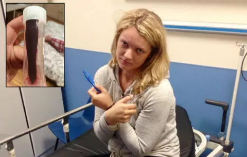 Mochilera británica vivió con una sanguijuela en su nariz por más de un mes