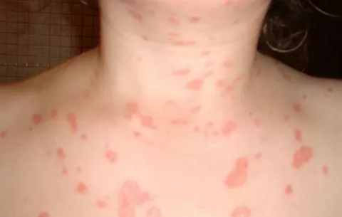 Una terapia mejora el blanqueo de la piel en pacientes con psoriasis