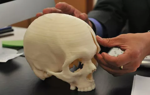 Colombiano recibe primer implante craneal 3D de titanio en Latinoamérica