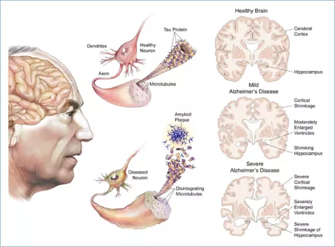 Proteína asociada al alzheimer puedría transmitirse por instrumentos
