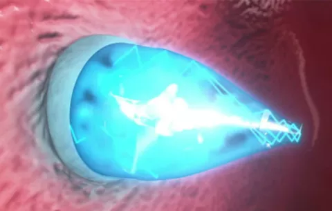 Catéter con luz ultravioleta evitaría cirugías a corazón abierto