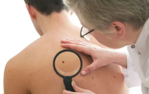 El número de lunares del brazo puede alertar de cáncer de piel