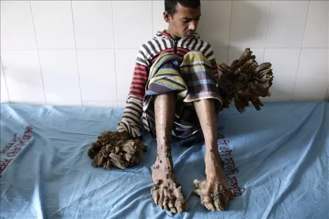 Un hospital de Bangladesh se prepara para operar al "hombre árbol"