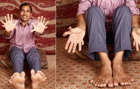El hombre con más dedos en el mundo