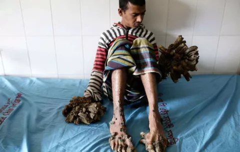 El "hombre árbol" de Bangladesh supera con éxito su primera operación