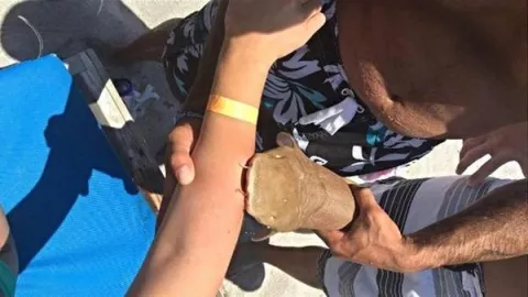 Mujer de Florida va al hospital con tiburón prendido al brazo