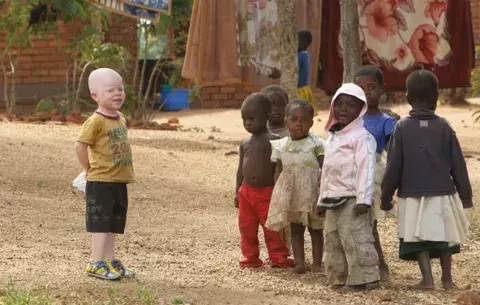 Aumenta el asesinato de albinos en Malaui 