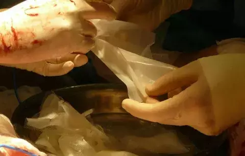 Realizan primer trasplante de piel fabricada con células del paciente