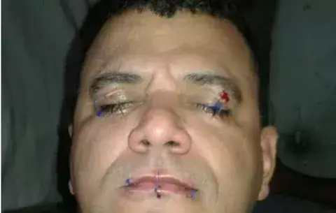 Privado de libertad se cose la boca y los ojos como medida de protesta