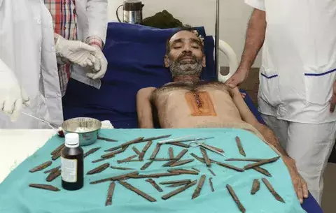 Extraen 40 cuchillos del estómago de un hombre en India 