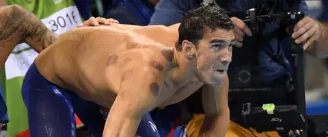 Los 'morados' en el cuerpo de Michael Phelps tienen su razón