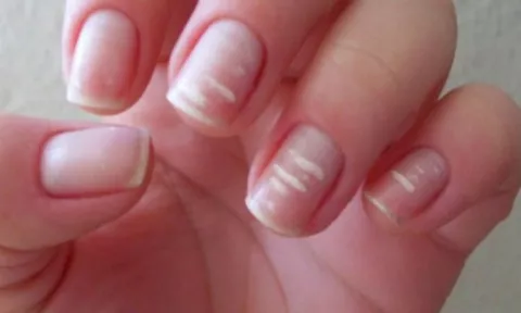 ¿Por qué aparecen manchas blancas en las uñas?