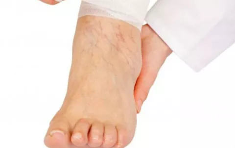 Trombosis: factores de riesgo y cómo prevenirla