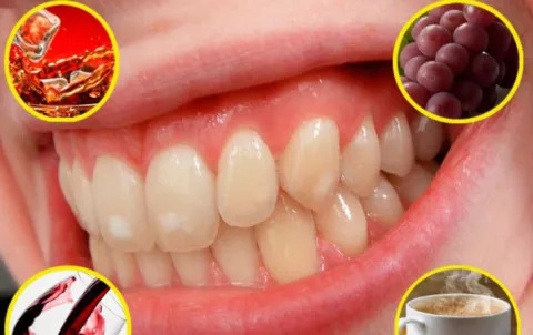 ¿Por qué los dientes se ponen amarillos?
