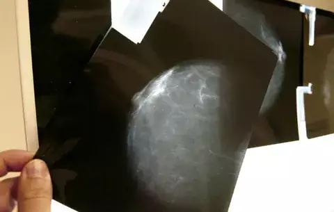 Mamografías pueden reducir un 40% la posibilidad de morir por cáncer de mama