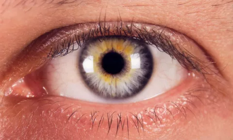 Cuidado con los depósitos de grasa en los ojos