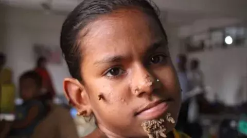 Diagnostican a una niña la enfermedad del "hombre árbol"