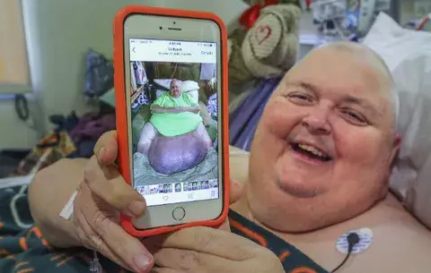 Extirpan tumor de 130 libras a un hombre 