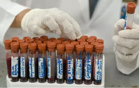 Chip detecta el VIH en la primera semana de infección