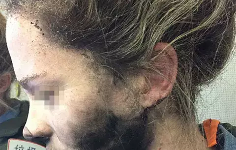 Sufre quemaduras al explotarle los auriculares en pleno vuelo