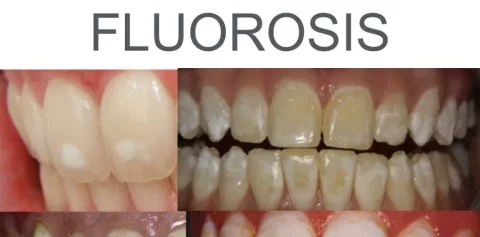 ¿Tienes los dientes manchados?