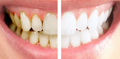 Los beneficios sobre las carillas porcelanas