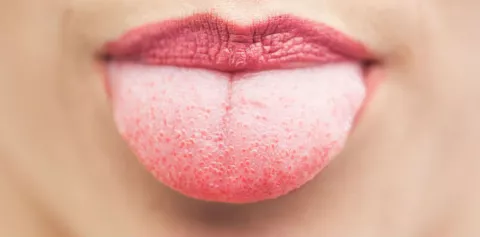 La consecuencias de tener la lengua blanca