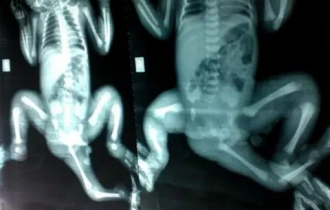Nueva vida para una niña de Bangladés nacida con tres piernas