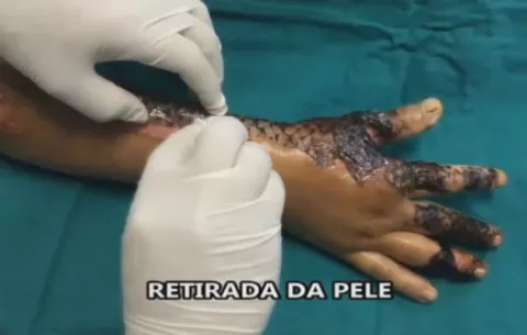 Curan quemaduras con piel de pescado en Brasil