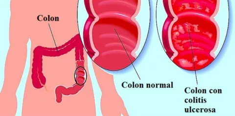 "Día Mundial de la Enfermedad Inflamatoria Intestinal"