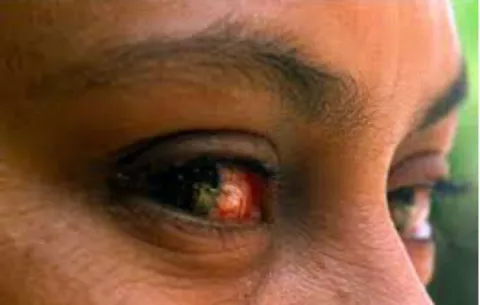 Minsa confirma brote de conjuntivitis en Colón