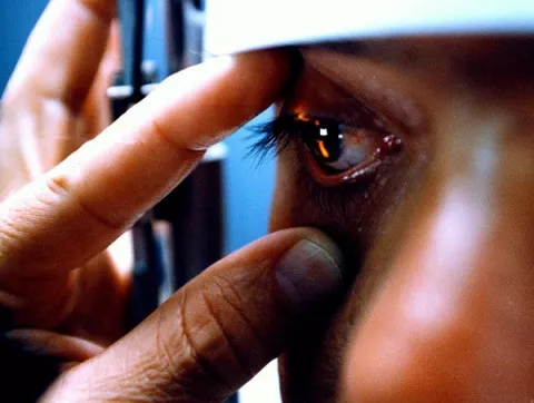 Ya son miles los casos de conjuntivitis  en Bocas del Toro