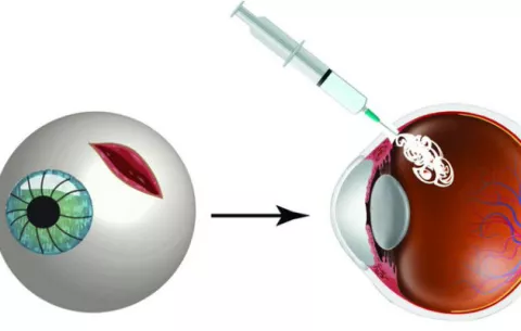 Pegamento permite curar heridas en los ojos antes de operar