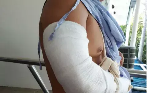 Investigan a policías que le fracturaron un brazo a futbolista con una vara