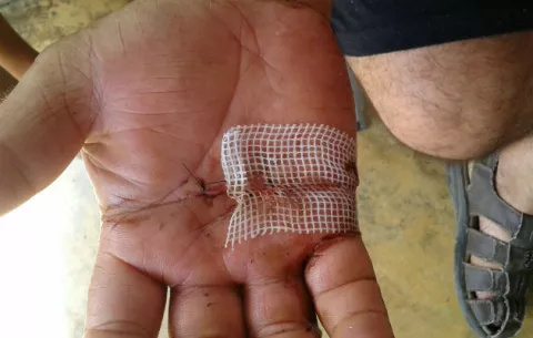 Hombre en Dolega es atacado ferozmente por dos perros 