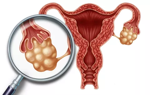 Sólo el 20% de los casos de cáncer de ovario se diagnostica en etapa temprana 