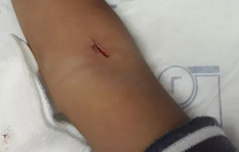 Menor es herido en brazo al extraerle sangre en la policlínica de La Chorrera