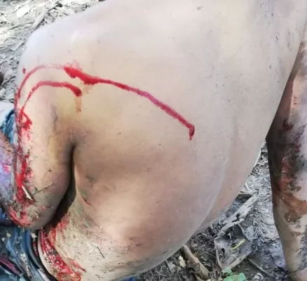 Muere joven de 22 años productos de las heridas por la explosión en fábrica pirotécnica en Barú