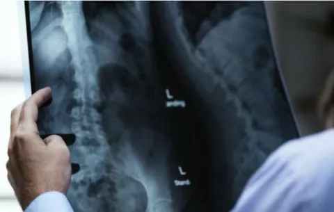 Minsa confirma dos casos de médicos contagiados de tuberculosis