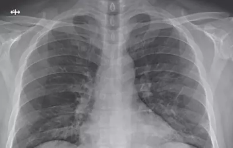 'Asintomáticos de COVID-19 van a  sufrir daños', advierte médico panameño