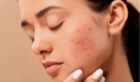Cuidados para la piel con dermatitis atópica