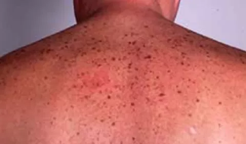 Bienestar: Daños en la piel por la exposición al sol