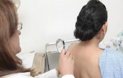 Minsa: El cáncer de piel es una amenaza latente en la sociedad panameña